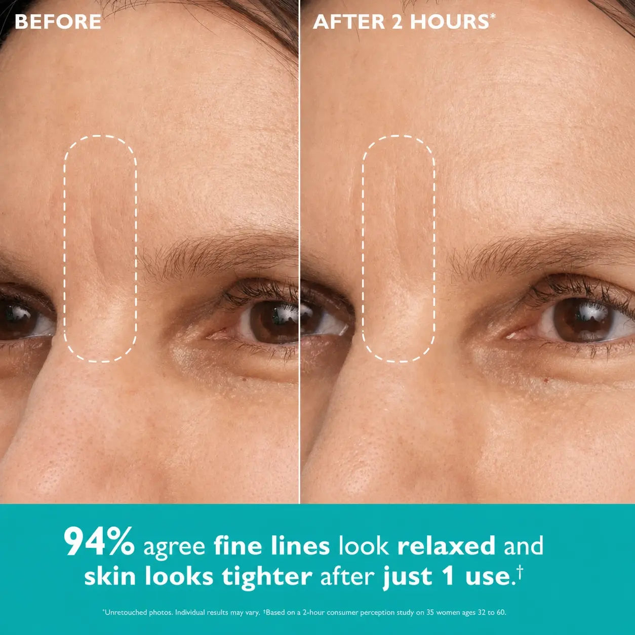 Aura Skin Care - Expression Lines Remover™